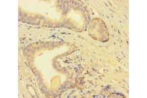 Immunohistochemistry of paraffin-embedded human prostate cancer using ABIN7173233 at dilution of 1:100 (TMEM52B anticorps  (AA 61-183))