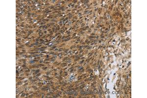 Immunohistochemistry of Human thyroid cancer using FOXB1 Polyclonal Antibody at dilution of 1:30 (FOXB1 anticorps)