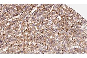 ABIN6279337 at 1/100 staining Human Melanoma tissue by IHC-P. (CST7 anticorps  (N-Term))
