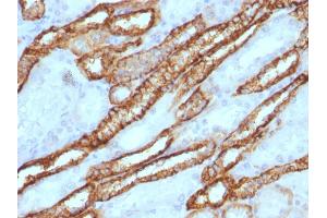 Formalin-fixed, paraffin-embedded human Renal Cell Carcinoma stained with KSP-Cadherin Rabbit Polyclonal Antibody. (Cadherin-16 anticorps)