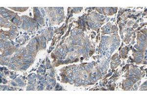 ABIN6273629 at 1/100 staining Human cervical cancer tissue by IHC-P. (GBP2 anticorps  (Internal Region))