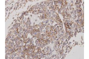Immunohistochemical staining of paraffin-embedded Lung CA using Flotillin 2 antibody at a dilution of 1:100 (Flotillin 2 anticorps)