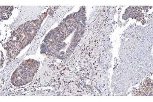 IHC-P Image Immunohistochemical analysis of paraffin-embedded human ovarian cancer, using ARID3A, antibody at 1:100 dilution. (ARID3A anticorps  (Internal Region))
