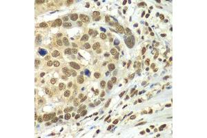 Immunohistochemistry of paraffin-embedded human esophageal cancer using HDAC2 antibody. (HDAC2 anticorps  (C-Term))