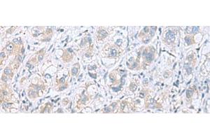 Immunohistochemistry of paraffin-embedded Human liver cancer tissue using GPCPD1 Polyclonal Antibody at dilution of 1:55(x200) (GPCPD1 anticorps)