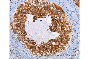 Immunohistochemistry of Human cervical cancer using KRT13 Polyclonal Antibody at dilution of 1:35