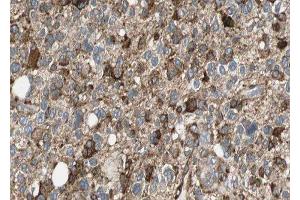 ABIN6277081 at 1/100 staining human Glioma tissue sections by IHC-P. (NGFR anticorps  (Internal Region))