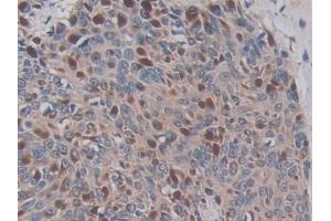 Detection of ADAM17 in Human Skin cancer Tissue using Monoclonal Antibody to A Disintegrin And Metalloprotease 17 (ADAM17)