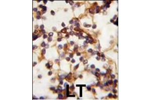 Formalin-fixed and paraffin-embedded human Lymph tissue reacted with Rictor antibody (N-term) (ABIN391384 and ABIN2841392) , which was peroxidase-conjugated to the secondary antibody, followed by DAB staining. (RICTOR anticorps  (N-Term))