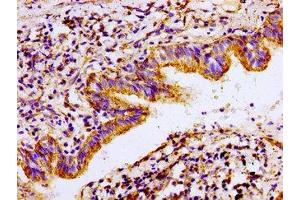 Immunohistochemistry of paraffin-embedded human lung cancer using ABIN7143021 at dilution of 1:100 (ACO2 anticorps  (AA 452-676))