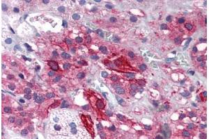 Human Adrenal (formalin-fixed, paraffin-embedded) stained with GRIK1 antibody ABIN343898 at 5 ug/ml followed by biotinylated goat anti-rabbit IgG secondary antibody ABIN481713, alkaline phosphatase-streptavidin and chromogen. (GRIK1 anticorps  (Internal Region))