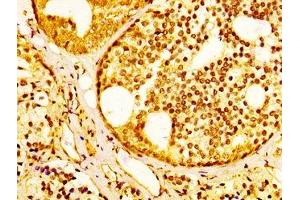 IHC image of ABIN7170259 diluted at 1:300 and staining in paraffin-embedded human prostate cancer performed on a Leica BondTM system. (SLC45A3 anticorps  (AA 408-487))