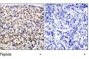 Immunohistochemical analysis of paraffin-embedded human breast carcinoma tissue using CREB1 polyclonal antibody  . (CREB1 anticorps  (Ser129))