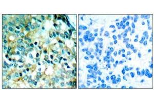 Immunohistochemical analysis of paraffin- embedded human breast carcinoma tissue using Src (phospho- Tyr418) antibody. (Src anticorps  (pTyr418))