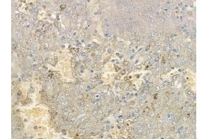 ABIN6265106 and ABIN6277039 at 1/100 staining human melanoma by IHC-P. (SLAMF1 anticorps  (C-Term))