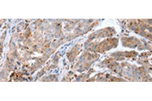 Immunohistochemistry of paraffin-embedded Human breast cancer tissue using CALB2 Polyclonal Antibody at dilution of 1:25(x200) (Calretinin anticorps)