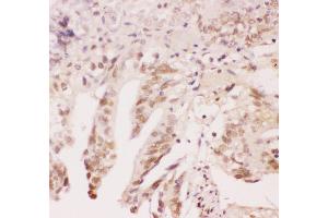 Anti-ATF1 Picoband antibody,  IHC(P): Human Intestinal Cancer Tissue