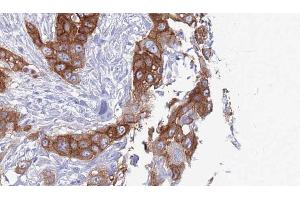 ABIN6272741 at 1/100 staining Human Head and neck cancer tissue by IHC-P.