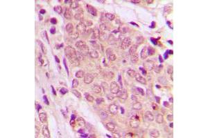 Immunohistochemical analysis of SMAD2/3 staining in human breast cancer formalin fixed paraffin embedded tissue section. (Smad2/3 anticorps  (N-Term))