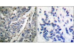Immunohistochemistry analysis of paraffin-embedded human breast carcinoma, using Synaptotagmin (Phospho-Thr202) Antibody.