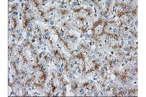 Immunohistochemical staining of paraffin-embedded Carcinoma of liver tissue using anti-MTRF1L mouse monoclonal antibody. (MTRF1L anticorps)