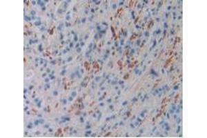 IHC-P analysis of Human Prostate Gland Cancer Tissue, with DAB staining. (FLNC anticorps  (AA 17-259))