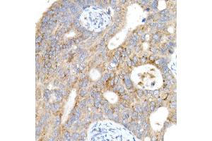 Immunohistochemistry of paraffin-embedded human colon carcinoma using Cation-independent M6PR (IGF2R) antibody (ABIN7267905) at dilution of 1:200 (40x lens). (IGF2R anticorps)