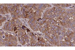 ABIN6273838 at 1/100 staining Human liver cancer tissue by IHC-P. (HTR3E anticorps  (Internal Region))