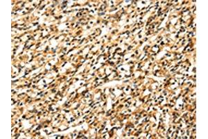 The image on the left is immunohistochemistry of paraffin-embedded Human prostate cancer tissue using ABIN7131054(SIGLEC12 Antibody) at dilution 1/35, on the right is treated with fusion protein. (SIGLEC12 anticorps)