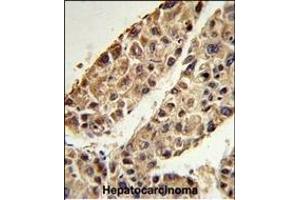 Formalin-fixed and paraffin-embedded human hepatocarcinoma reacted with ITIH2 Antibody (C-term), which was peroxidase-conjugated to the secondary antibody, followed by DAB staining. (ITIH2 anticorps  (C-Term))