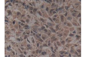 Detection of GLG1 in Human Lung cancer Tissue using Polyclonal Antibody to Golgi Glycoprotein 1 (GLG1)