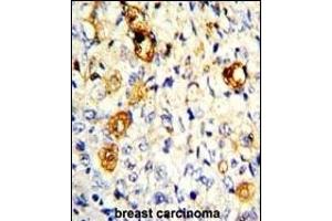 Formalin-fixed and paraffin-embedded human breast carcinoma with P19 Antibody (C-term), which was peroxidase-conjugated to the secondary antibody, followed by DAB staining. (MMP19 anticorps  (C-Term))