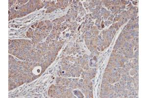 IHC-P Image Immunohistochemical analysis of paraffin-embedded SW480 xenograft, using MRCK alpha, antibody at 1:100 dilution.
