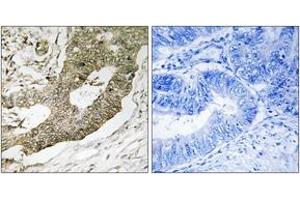 Immunohistochemistry analysis of paraffin-embedded human colon carcinoma tissue, using NUCKS1 Antibody. (NUCKS1 anticorps  (AA 28-77))