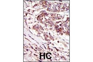 Formalin-fixed and paraffin-embedded human cancer tissue reacted with the primary antibody, which was peroxidase-conjugated to the secondary antibody, followed by AEC staining.
