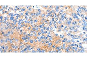 Immunohistochemistry of paraffin-embedded Human ovarian cancer tissue using HCN2 Polyclonal Antibody at dilution 1:80 (HCN2 anticorps)