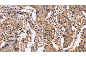Immunohistochemistry of paraffin-embedded Human lung cancer using IDH1 Polyclonal Antibody at dilution of 1:50 (IDH1 anticorps)