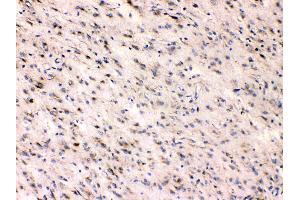 Beta III Tubulin was detected in paraffin-embedded sections of human glioma tissues using rabbit anti- Beta III Tubulin Antigen Affinity purified polyclonal antibody (Catalog # ) at 1 µg/mL.