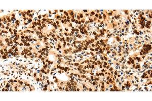 Immunohistochemistry of paraffin-embedded Human gastic cancer using Proliferating Cell Nuclear Antigen Polyclonal Antibody at dilution of 1:44 (PCNA anticorps)
