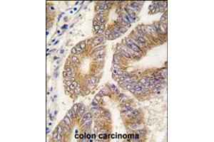 Formalin-fixed and paraffin-embedded human colon carcinoma tissue reacted with AHCY antibody , which was peroxidase-conjugated to the secondary antibody, followed by DAB staining.