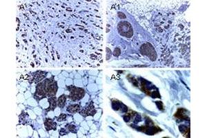 Immunohistochemical analysis of BIRC4 in formalin-fixed, paraffin-embedded human breast carcinoma. (XIAP anticorps)