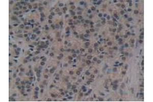 IHC-P analysis of Human Prostate Gland Cancer Tissue, with DAB staining. (ATG7 anticorps  (AA 429-488))
