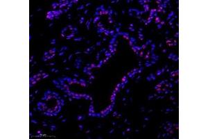 Immunofluorescence of paraffin embedded human breast cancer using tfiib (ABIN7074034) at dilution of 1: 500 (300x lens) (GTF2B anticorps)