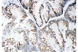 Anti-MMP14 antibody, IHC(P) IHC(P): Human Intestinal Cancer Tissue