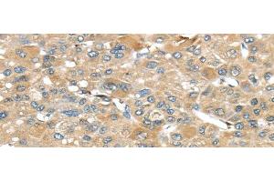 Immunohistochemistry of paraffin-embedded Human liver cancer tissue using SRP54 Polyclonal Antibody at dilution 1:45 (SRP54 anticorps)