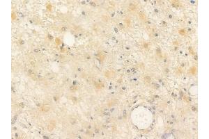 ABIN6254897 and ABIN6266562 at 1/100 staining human astrocytoma by IHC-P. (Neuregulin 1 anticorps  (N-Term))