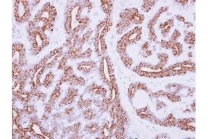 IHC-P Image Immunohistochemical analysis of paraffin-embedded human breast cancer, using IL3 Receptor alpha, antibody at 1:250 dilution.