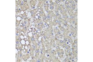 Immunohistochemistry of paraffin-embedded human liver injury using PIK3C2A antibody at dilution of 1:100 (x40 lens).