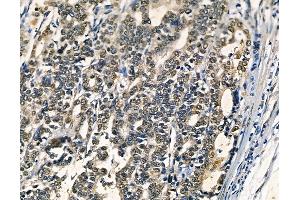 ABIN6262948 and ABIN6278588 at 1/100 staining human pancreatic cancer by IHC-P. (GAL4 anticorps  (N-Term))