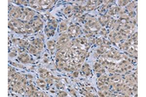 The image on the left is immunohistochemistry of paraffin-embedded Human thyroid cancer tissue using ABIN7129455(FAR2 Antibody) at dilution 1/50, on the right is treated with fusion protein. (FAR2 anticorps)